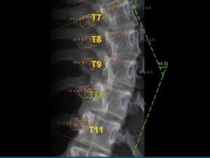 scoliosis-surgery1